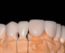 معرفی بخش پروتز های دندانی