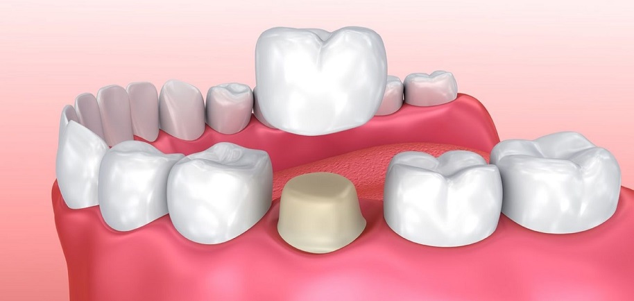 Dental-Crowns-Coral-Springs.jpg